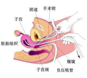 棕南医生详解:人流患者须知